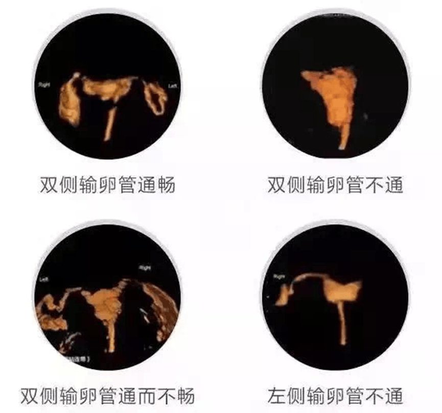 一文读懂输卵管造影