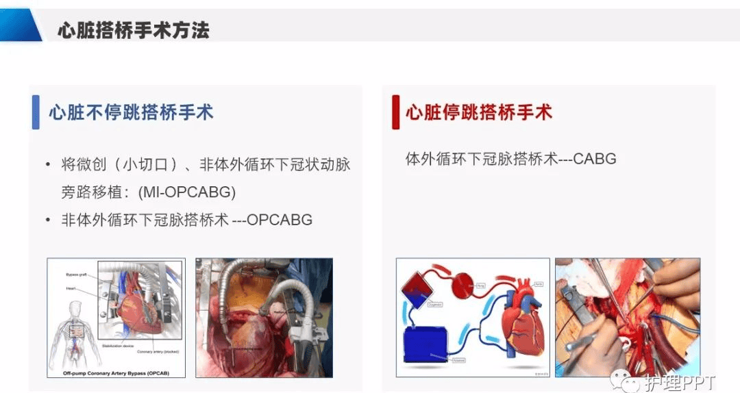 【ppt】冠脉搭桥患者护理查房（cabg）