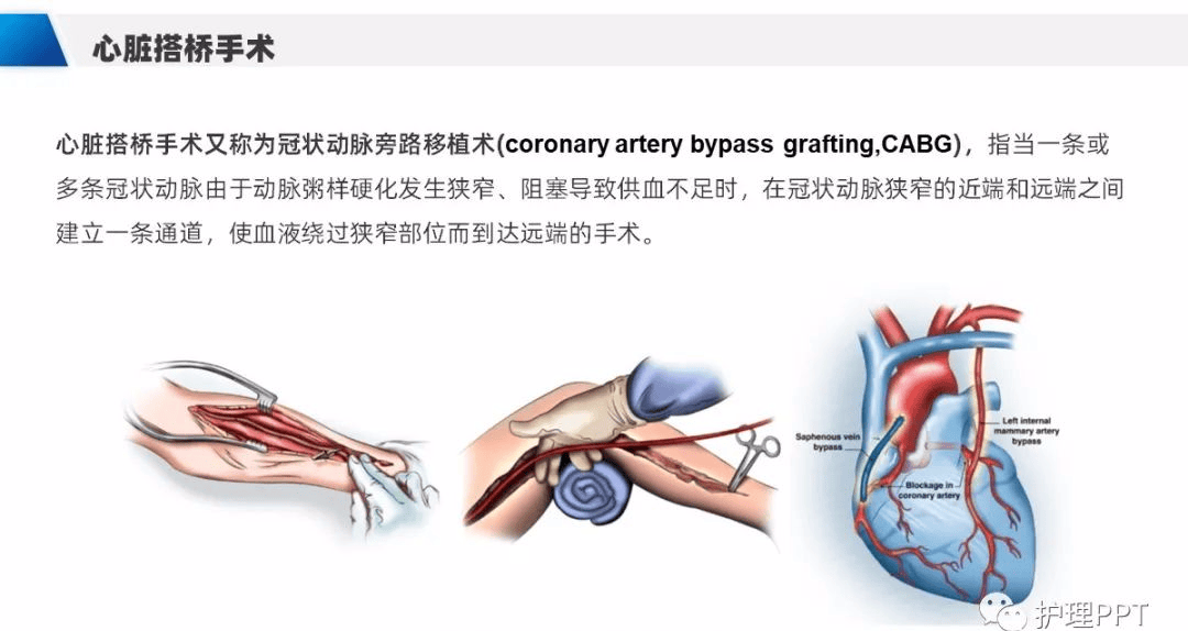 【ppt】冠脉搭桥患者护理查房（cabg）