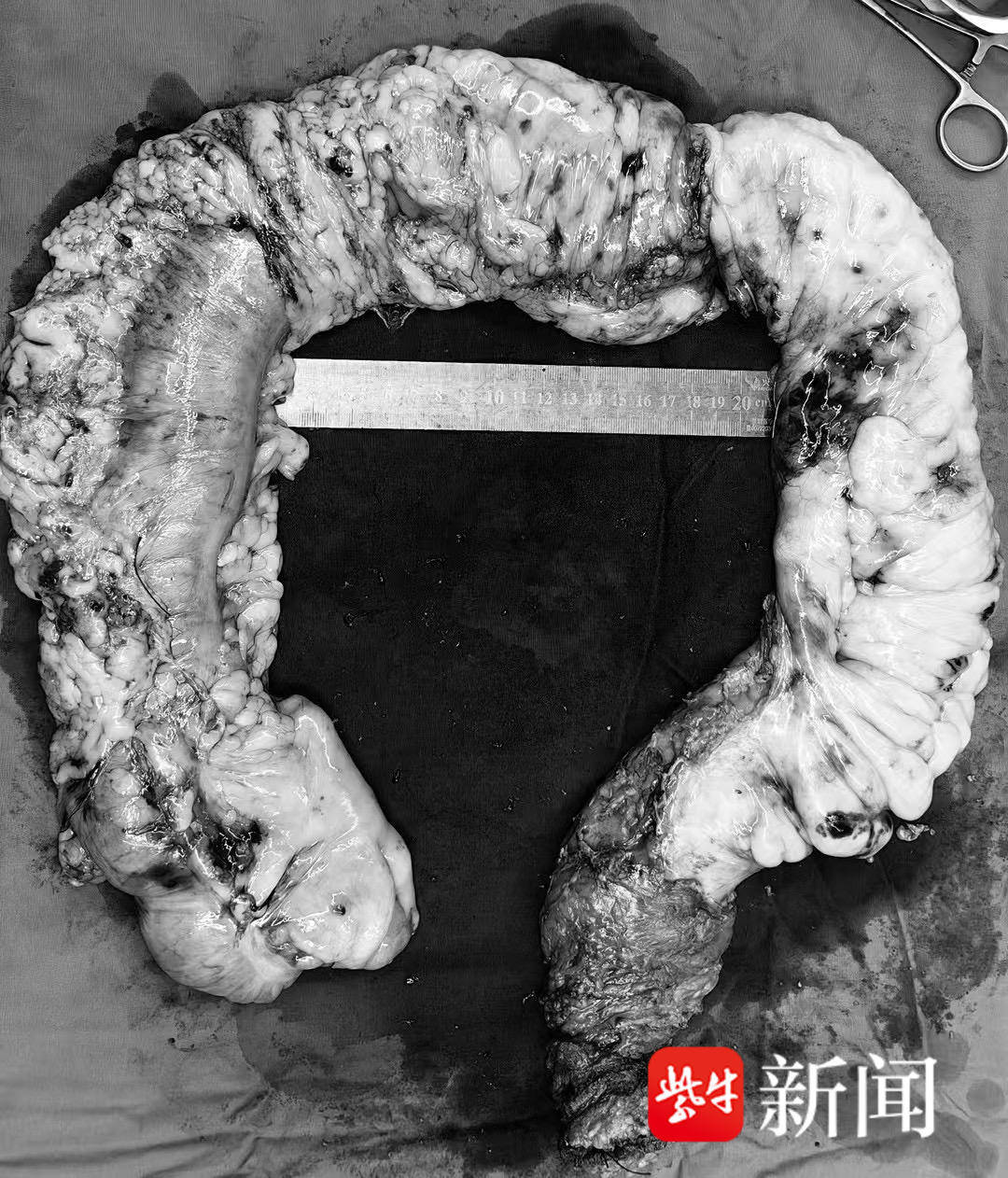 专家:家族病,难治!