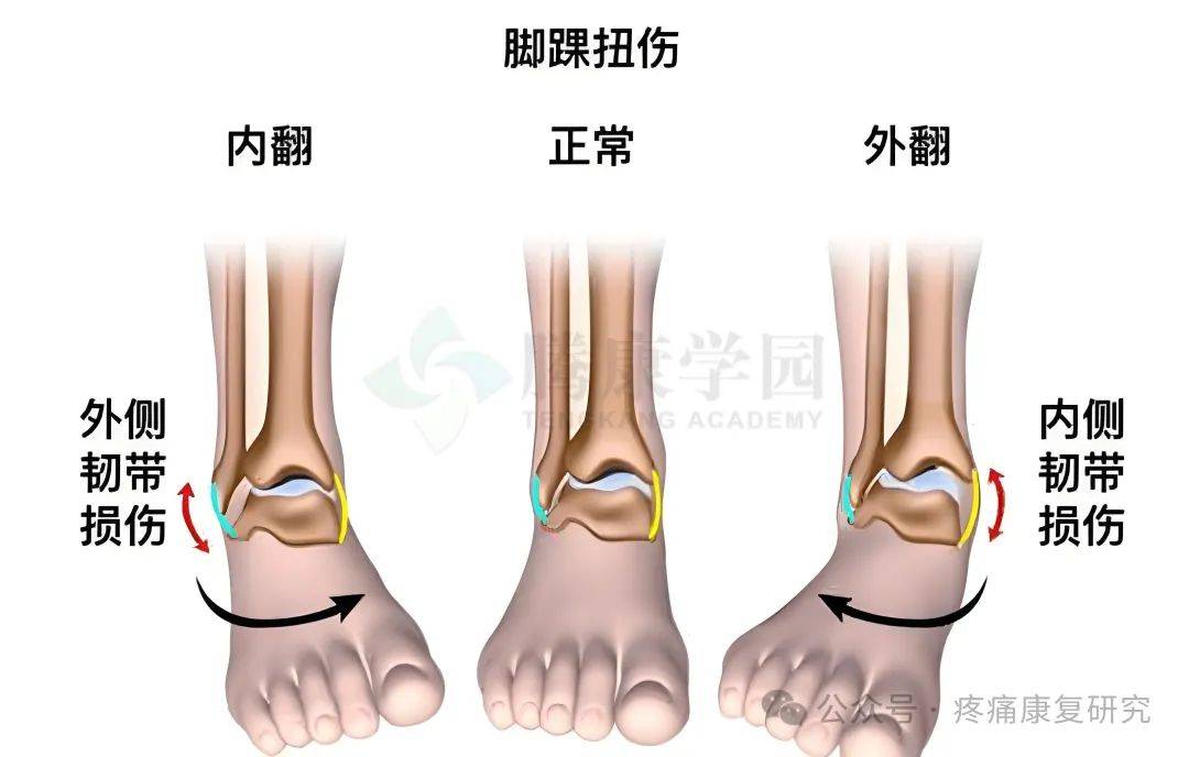 3 分钟 get!踝关节扭伤自救指南   康复训练秘籍