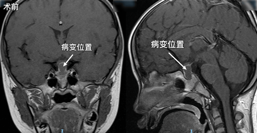 之儿童rathke囊肿,弥漫性星形细胞瘤