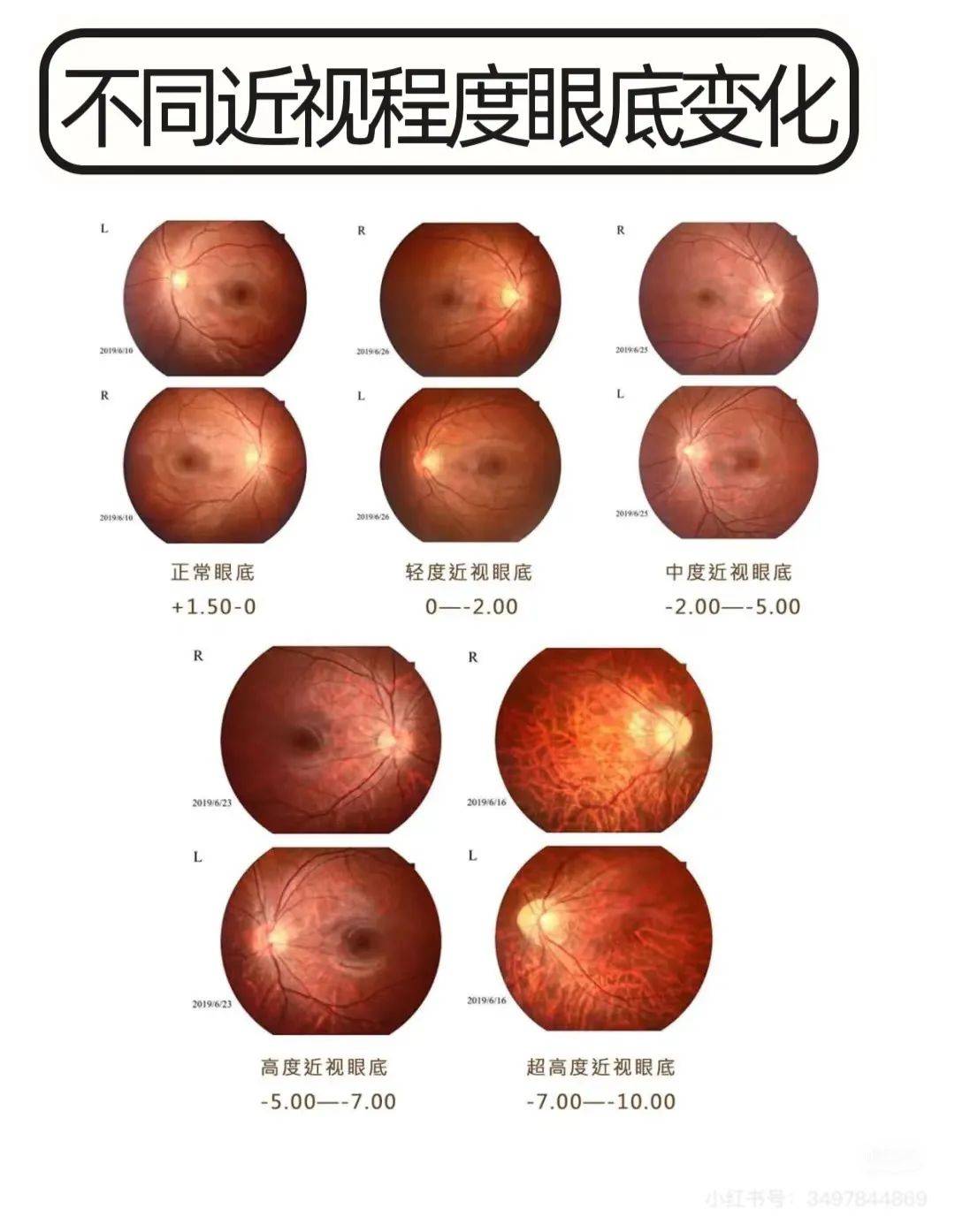 视网膜_风险_度数