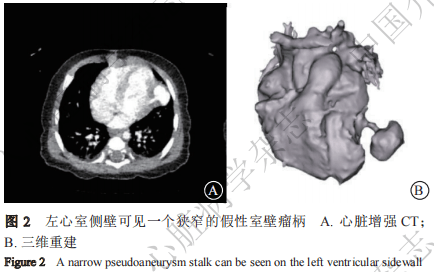 病例报告丨经皮封堵治疗先天性心脏病术后新发左心室假性室壁瘤1例