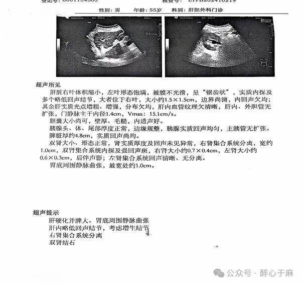 胃底周围静脉曲张;腹部超声(2024-10-21):脾脏囊肿,双肾囊肿