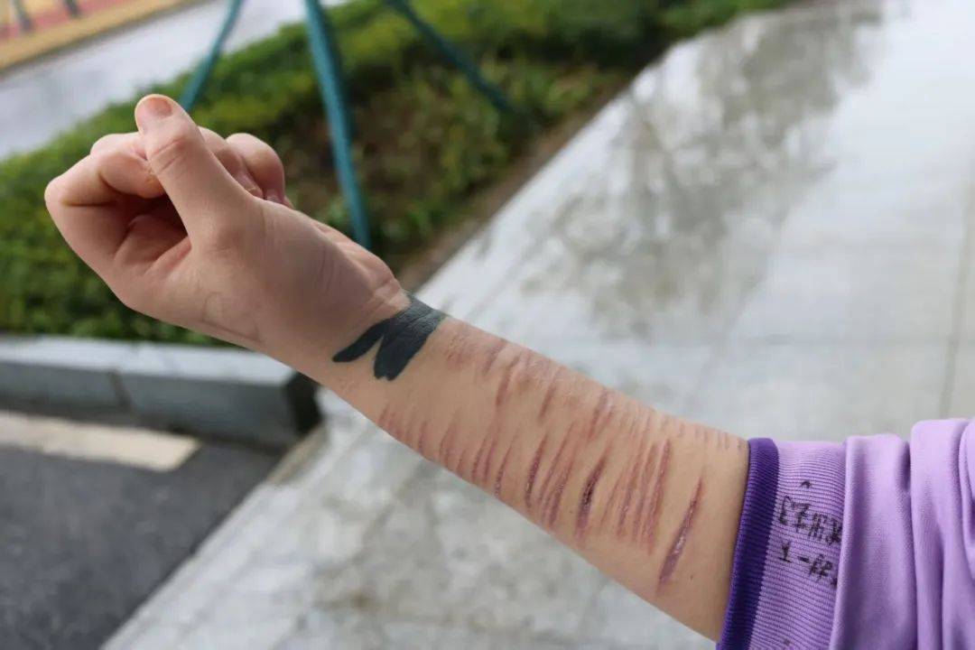 在戒毒康复所,掀开这些女孩的衣袖,白色手臂上都有着一道道触目惊心的