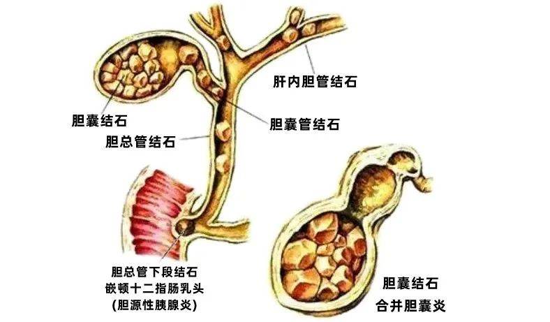 胶州:"三镜"联合手术,"巧取"胆结石