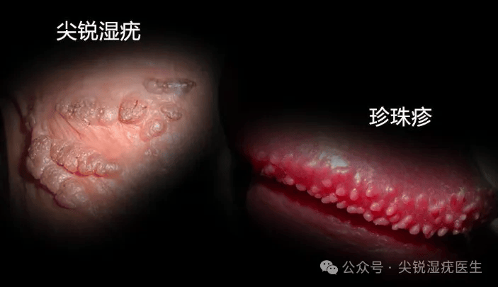 好发于男性龟头,冠状沟,包皮内侧,包皮系带,尿道口及阴茎根部,女性则