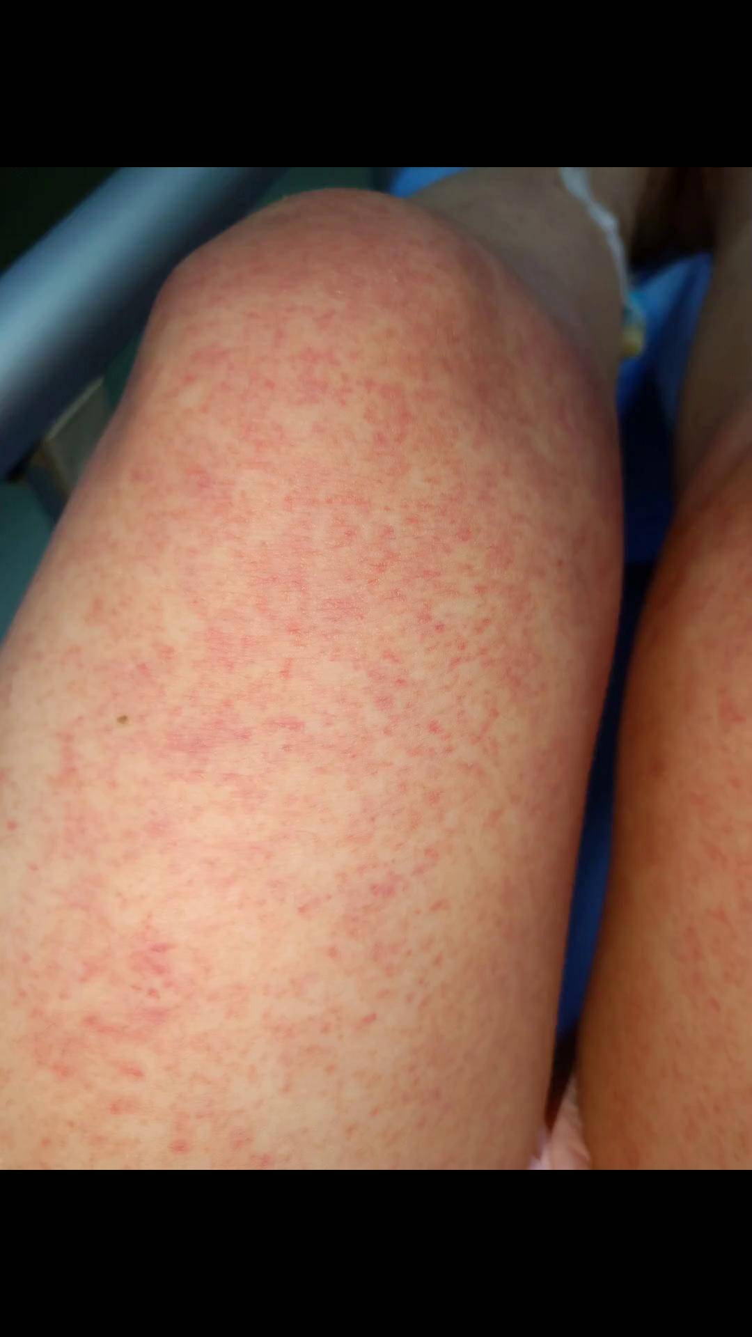 76,全身毛细血管破裂,命悬一线,几次住进重进监护室创作灵感