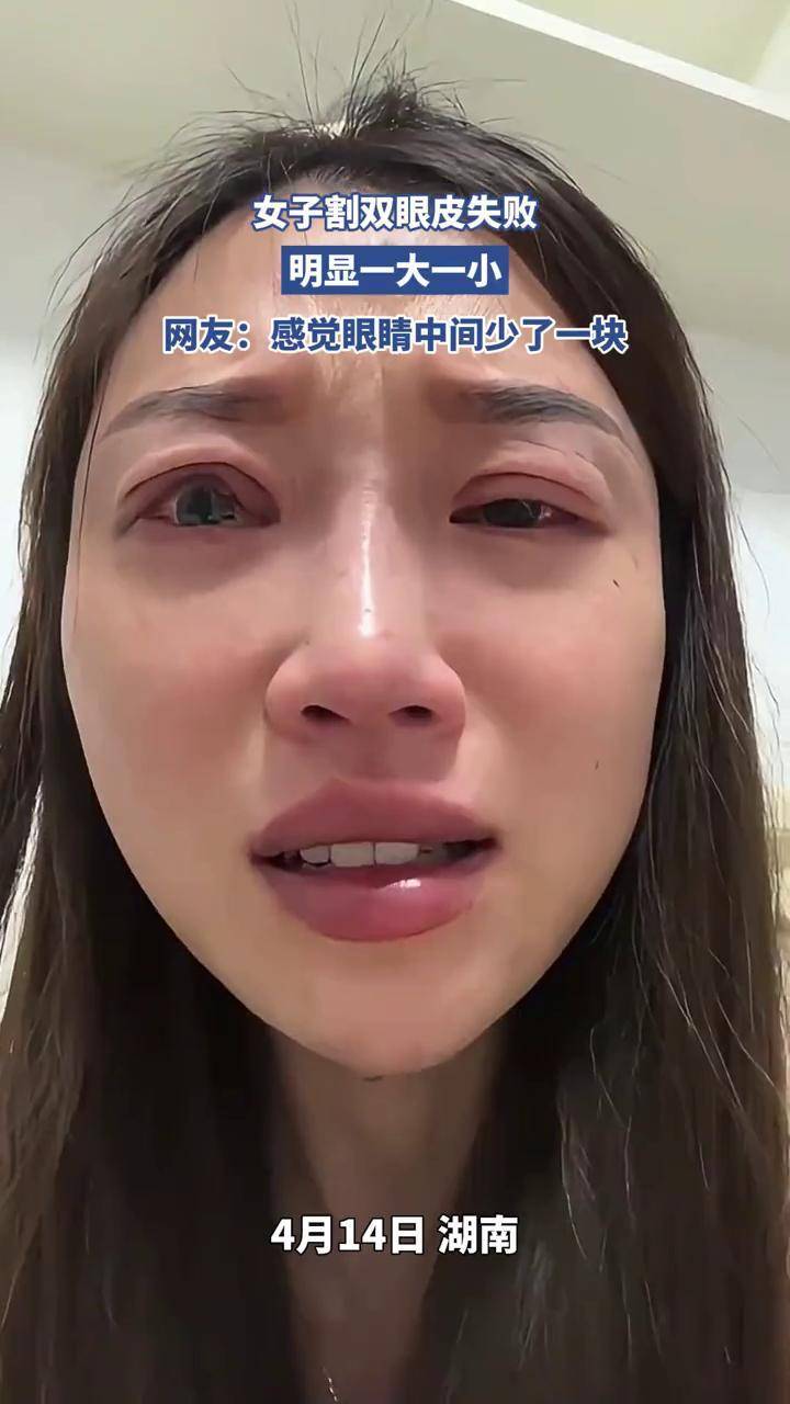女子割双眼皮失败,明显一大一小,网友:感觉眼睛中间少了一块