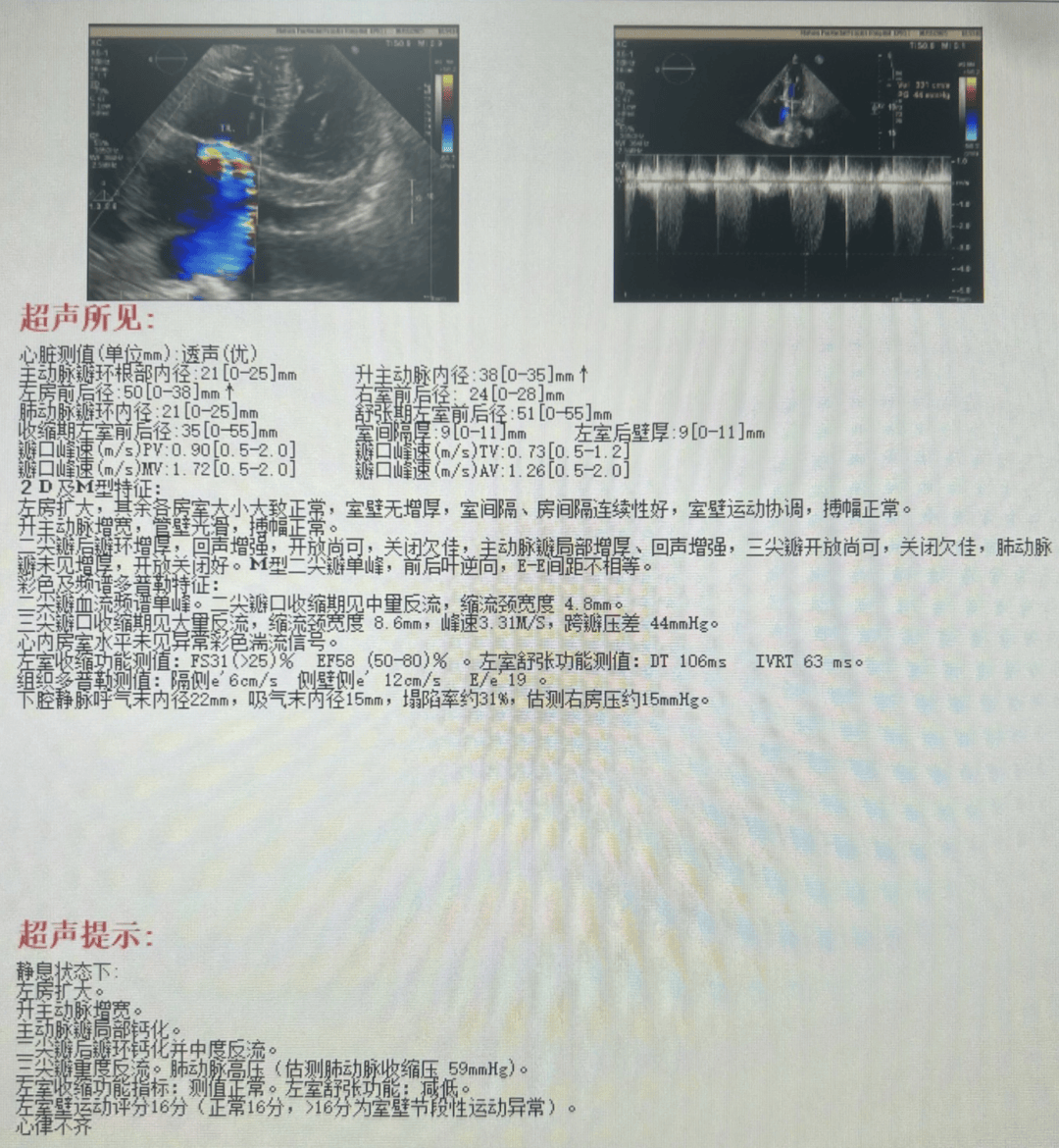 「耳术能详」flx丨随访病例专栏:敞口鸡翅型左心耳