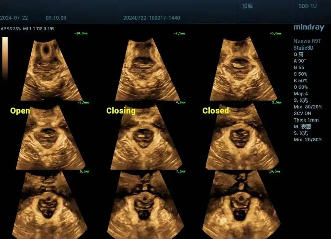 健康科普】“超”眼看盆底，您的盆底还好吗？_搜狐网