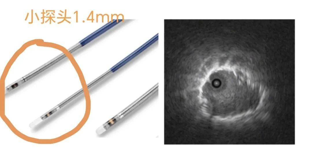 技术突破北京老年医院呼吸内科成功开展首例径向超声引导下经气管镜