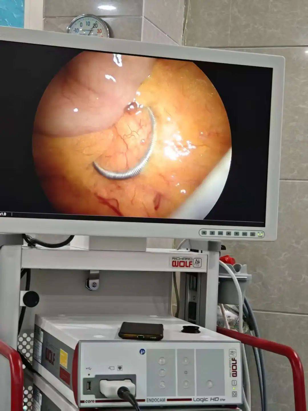 微创破难题!县妇幼成功摘除腹腔"游离"30年节育环