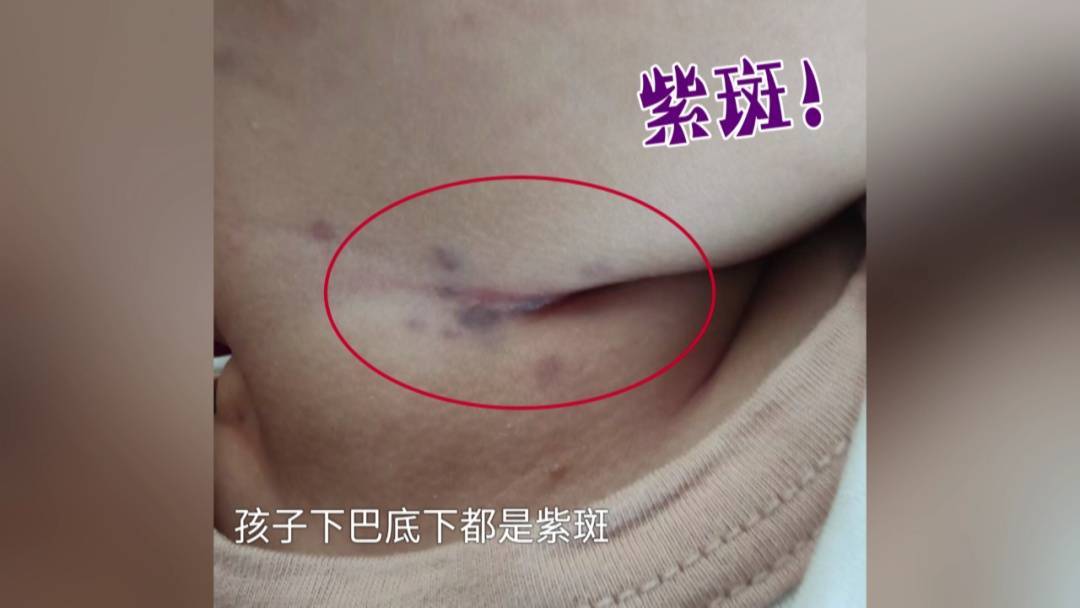 87天男婴身上突长紫斑,确诊急性髓系白血病!医生:可能和这些因素有关