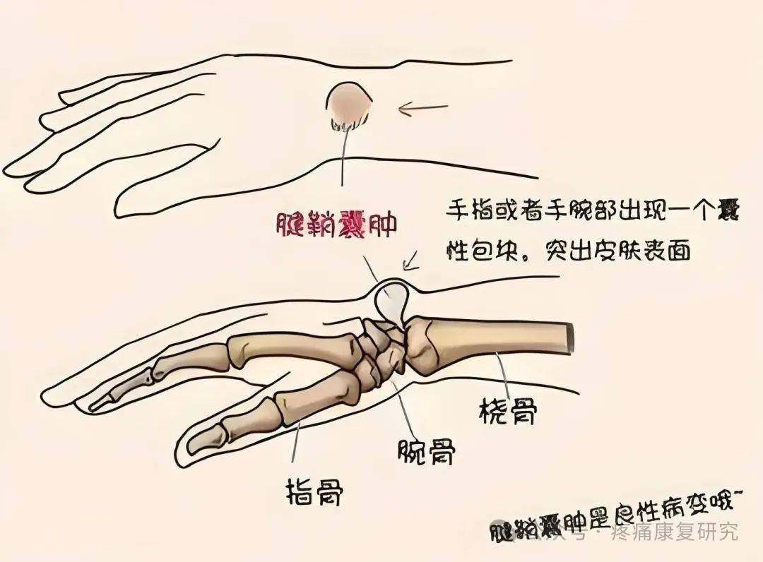 一种理论认为,腱鞘囊肿是一种