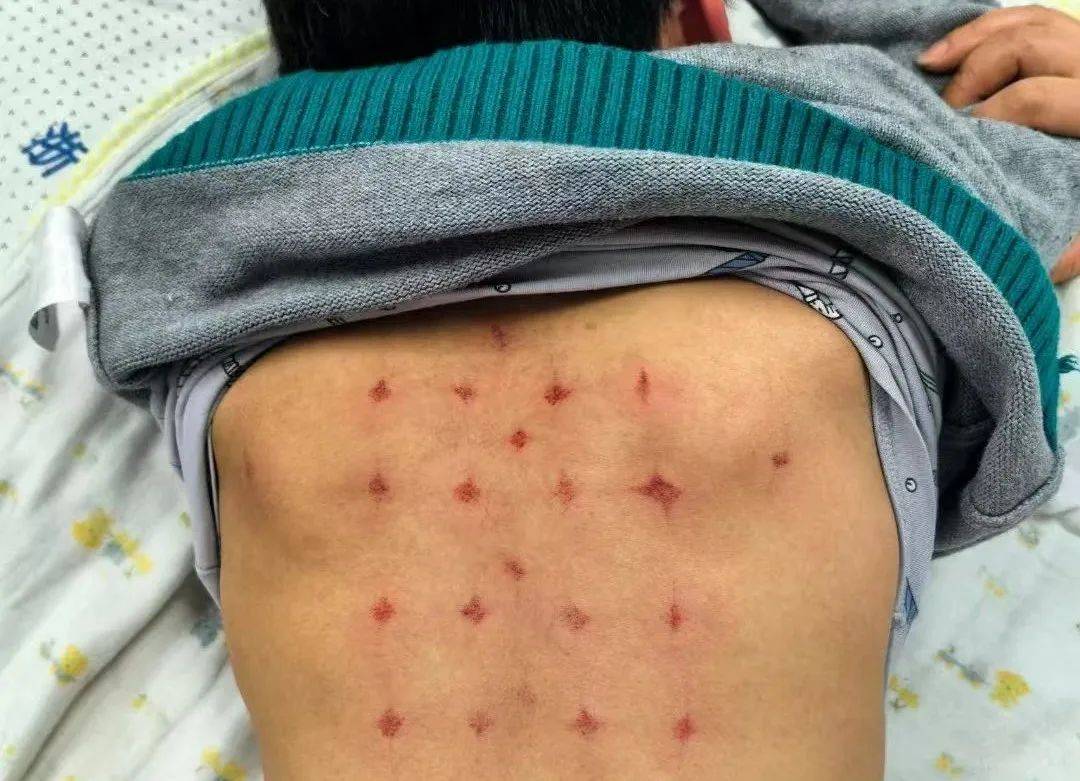 背上拔出8个"紫蘑菇"后,小孩哥嘴不臭了,胃口也变好了