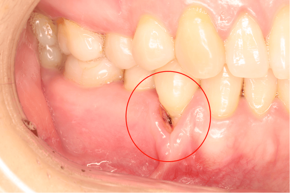 牙龈为什么会萎缩还有救吗