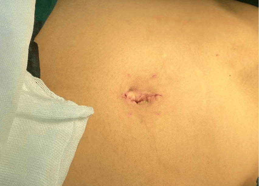 难题—46岁患者实现无痕微创全子宫切除