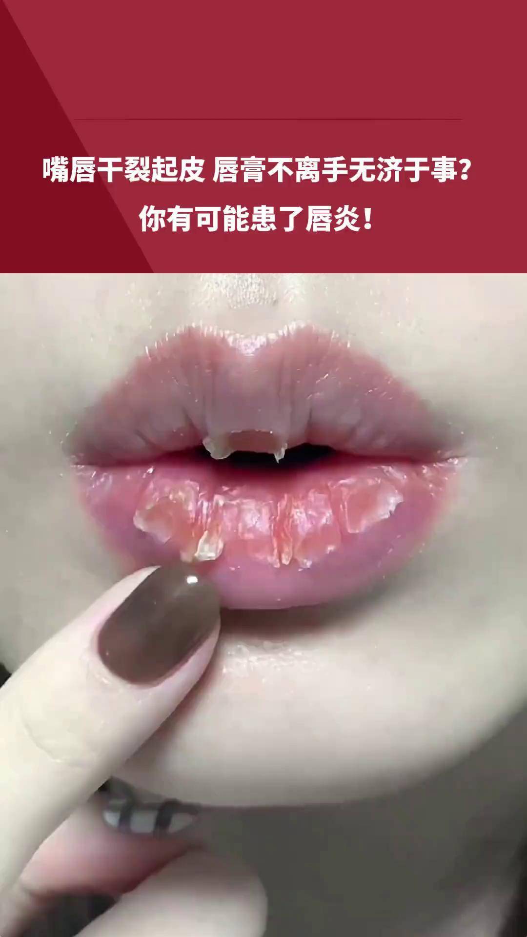 唇炎 唇膏