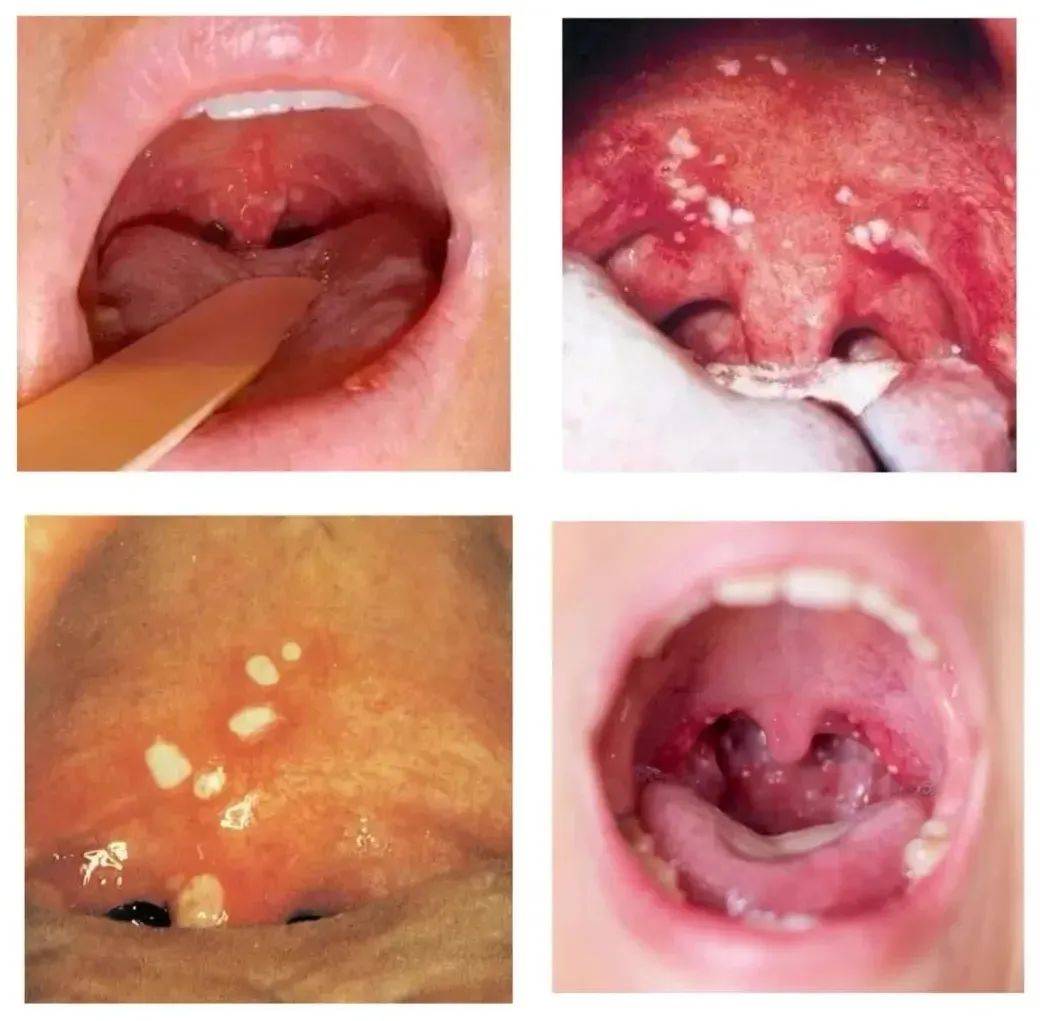 疱疹性咽峡炎是由肠道病毒引起的以急性发热和咽峡部疱疹溃疡为特征的