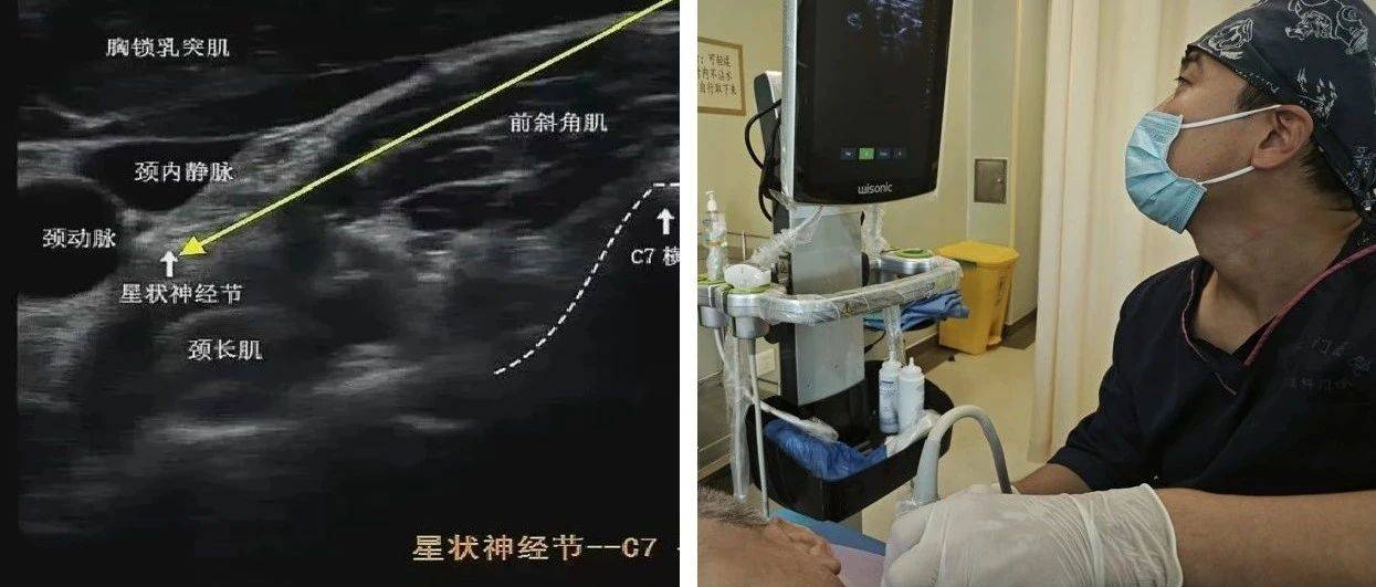 星状神经节阻滞,让你的神经放放松_治疗_调节_引导
