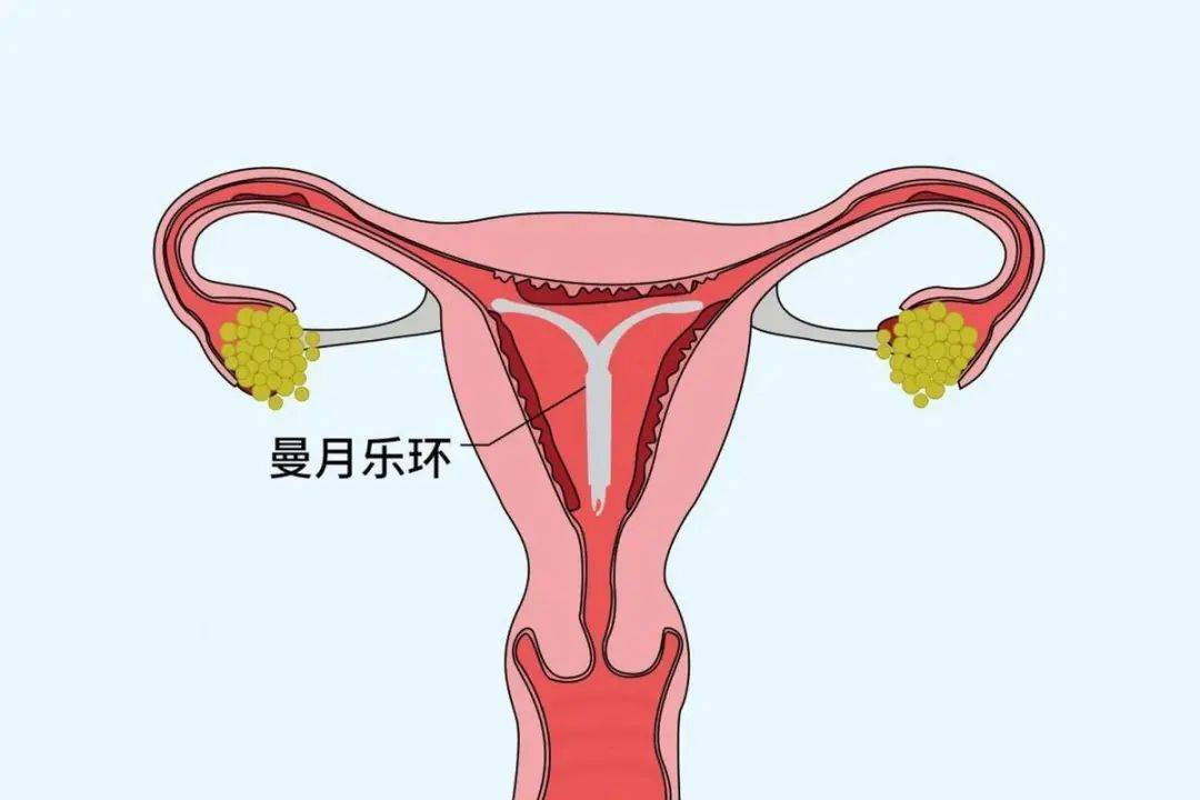 微创子宫切除术_杭州市一医院产科好吗_子宫腺肌症治疗