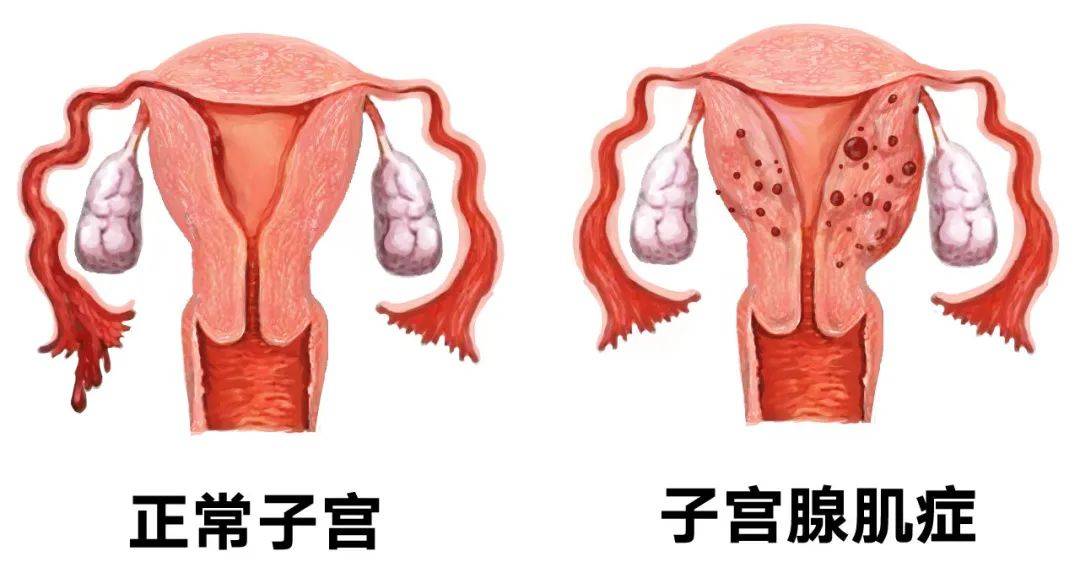 杭州市一医院产科好吗_微创子宫切除术_子宫腺肌症治疗