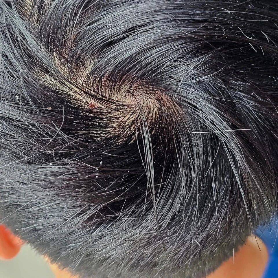 为什么每个人的头发都有“旋”？“两个旋”真的更聪明？_方向会_理论_研究