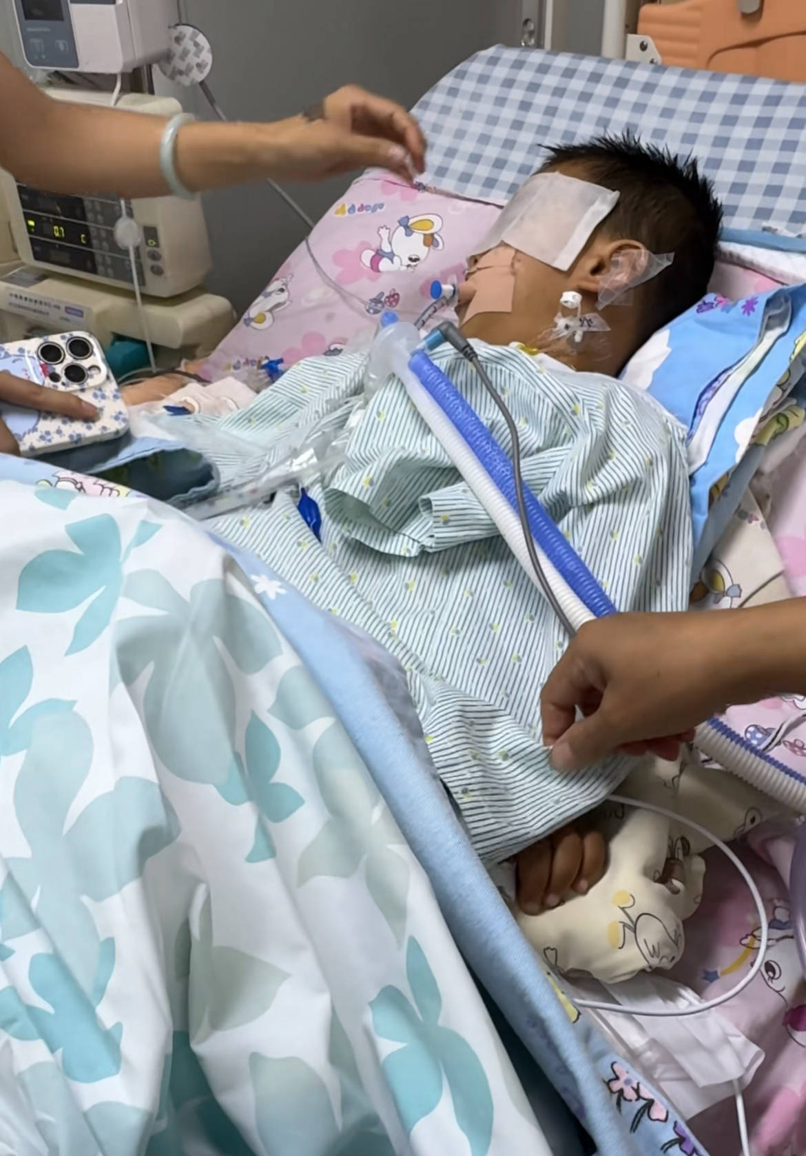 3岁男孩做扁桃体切除手术致脑死亡