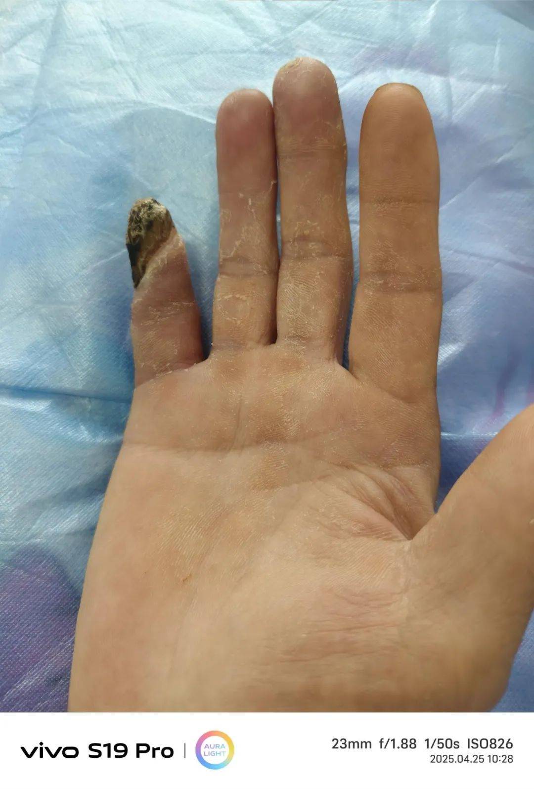 冻伤致残,几欲截肢;幸遇良医,保全手指