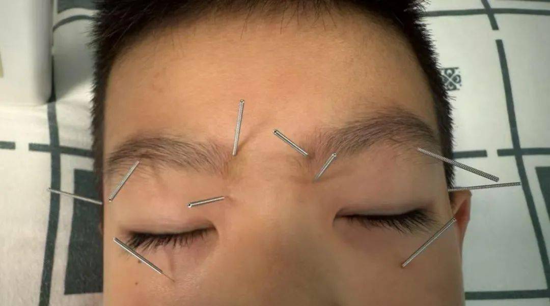 3种中医传统疗法来帮忙!