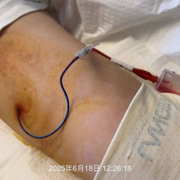 picc 导管滑脱 感染 疑似堵管,护士第一反应,先别拔管!