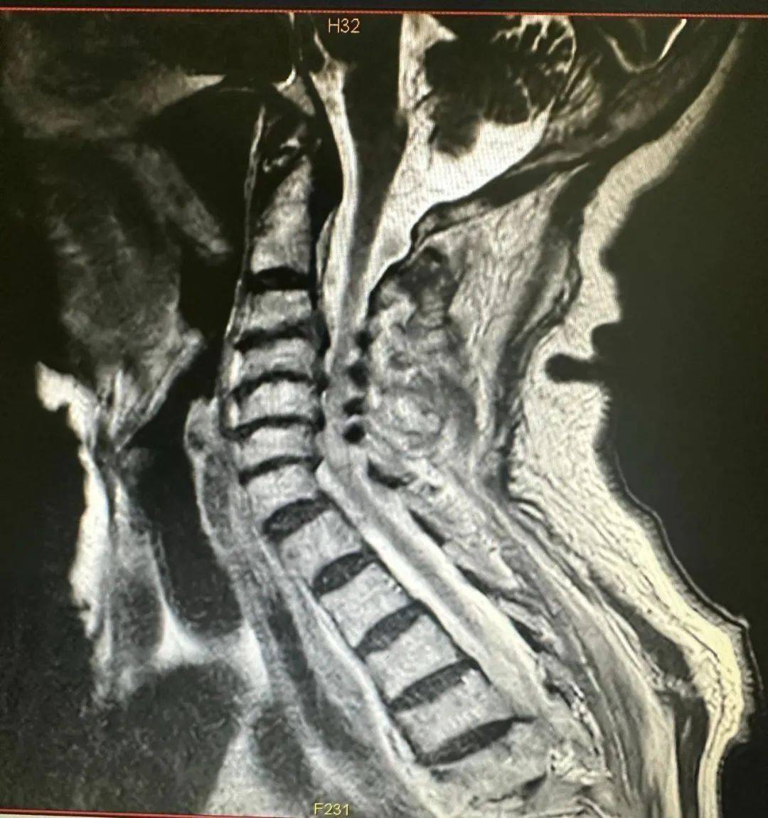 骨科一挑战高龄四级手术成功让90岁颈椎骨折患者站了起来