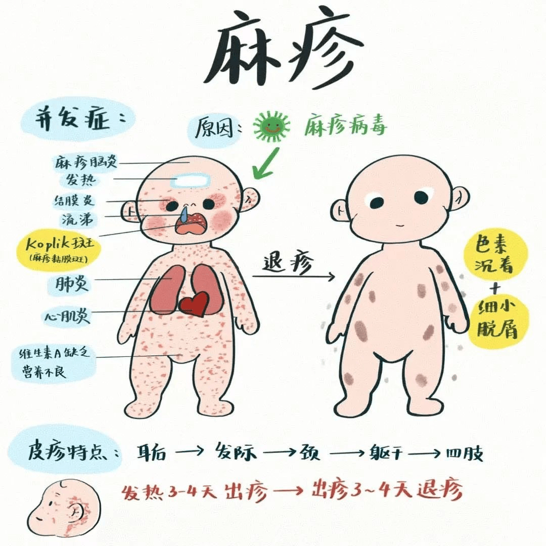 和麻疹"躲猫猫" ️