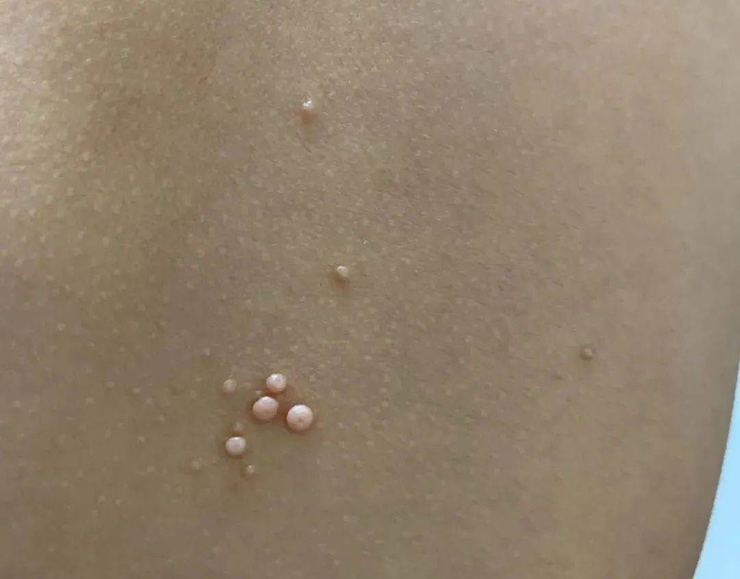 传染性软疣通常表现为突出皮肤表面的小圆疱疱,多是肤色或淡粉色,有