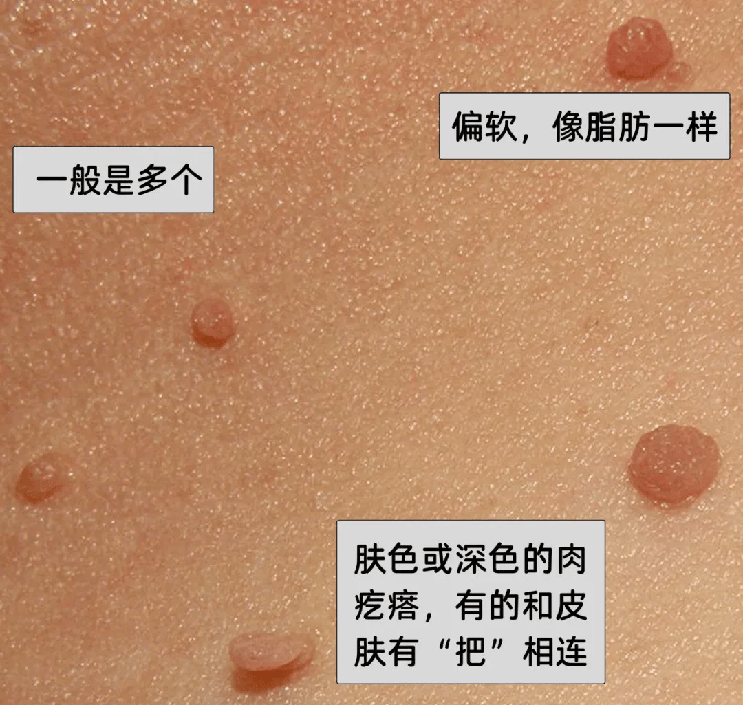 脖子上长出的小肉粒，能揪吗？