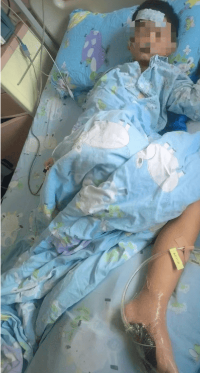 男孩沙滩光脚踩到死鱼，高烧呕吐！紧急入院