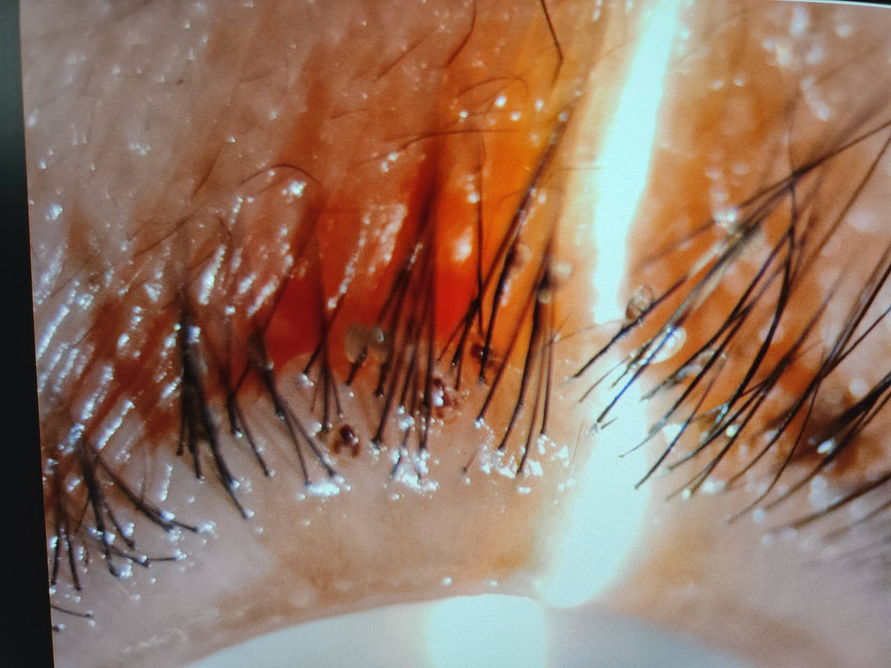 可怕!女子一到晚上眼睛就发痒,医生竟发现其睫毛上附着十多只虫