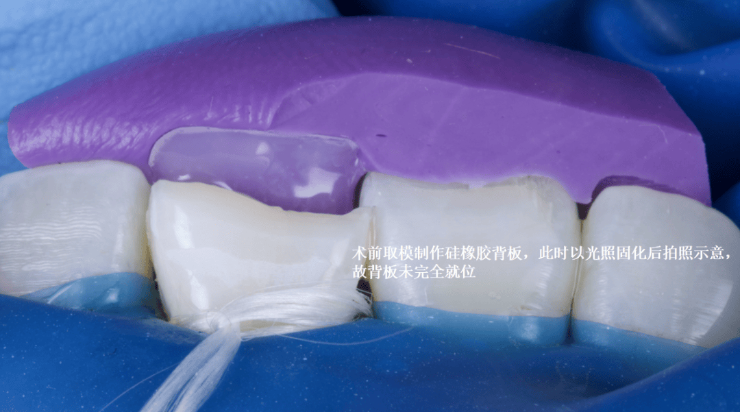 a2充填牙釉质层,毛刷抚平各个方向光固化30s拆除橡皮障后即刻照铅笔画