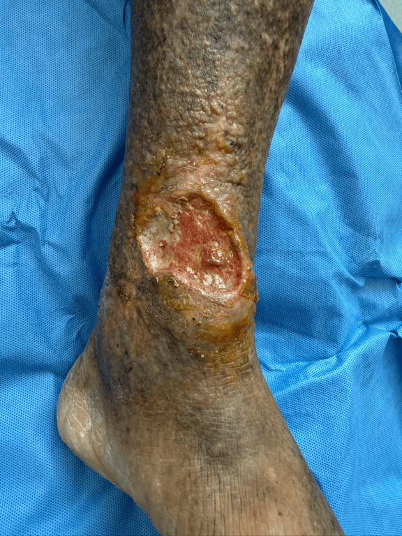 警惕!可能造成"老烂腿"