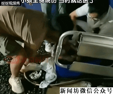 痛心！3岁男童不慎掉进炭火堆，全身85%烧伤，母亲徒手救出