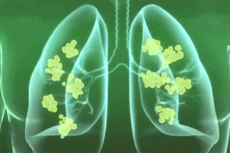 它就像活性炭一样,吸附呼吸系统有害物质,减少对肺部的伤害