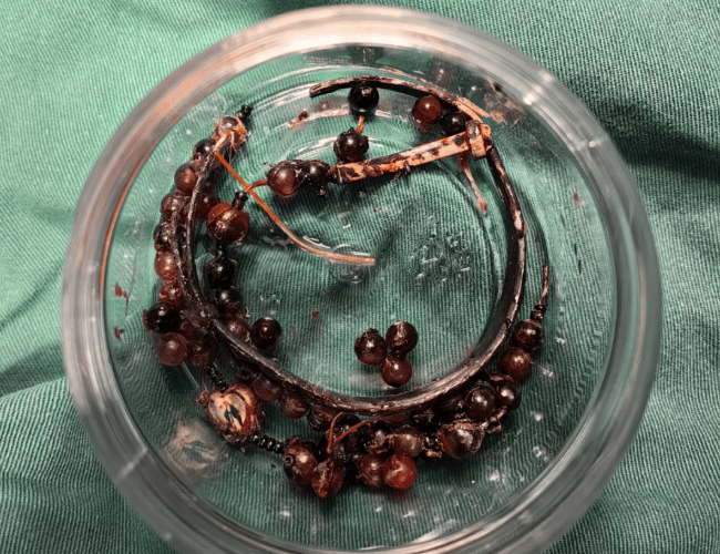 女子手镯10年没摘竟“长”进肉里!医生:再晚点可能危及生命