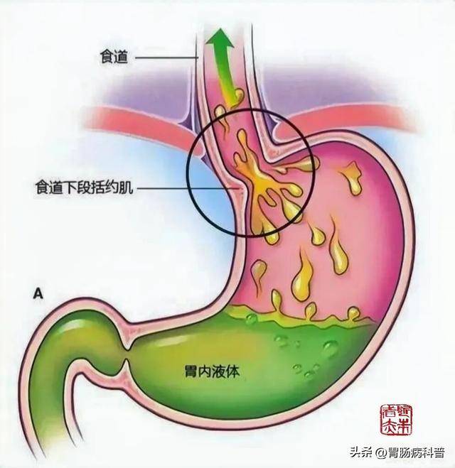 警惕！这些药物可能诱发或加重胃食管反流病_症状_括约肌_部分