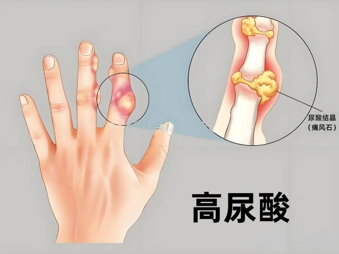 【健康科普】尿酸高、痛风总犯？记住这 几 招，比吃药还管用！