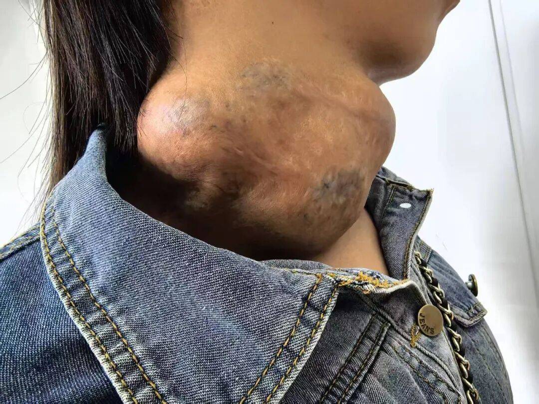 居然忍20年！女子脖子上长一串“土豆”，窒息还致命！医生：高危人群发病更凶险