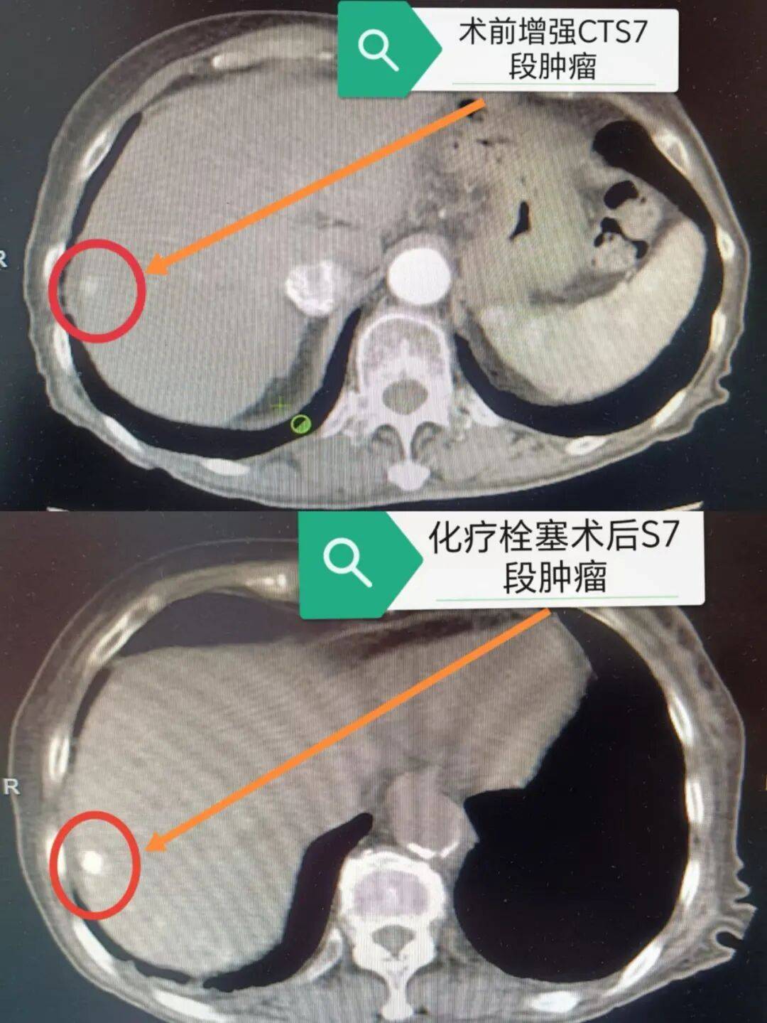这位特殊的患者因肝内多发占位就诊影像学检查提示两个病灶均符合