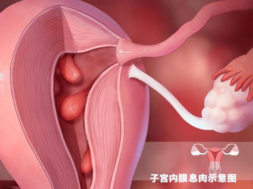 藏在子宫里的“不速之客”，宫腔镜让它无处遁形