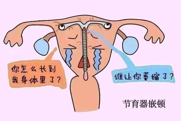 当“节育环”长进肉里，宫腔镜如何帮女性解决困扰？